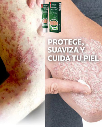 Psoriasis Cream – Crema para Psoriasis